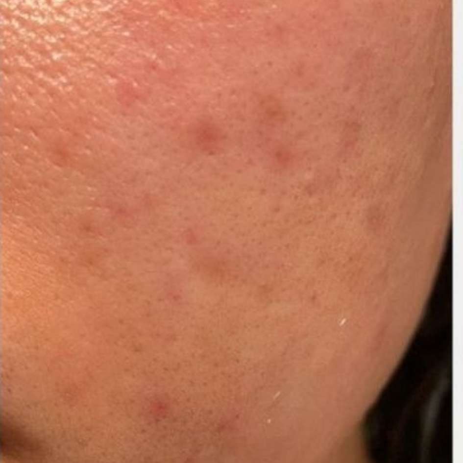visage joue rouge  Image